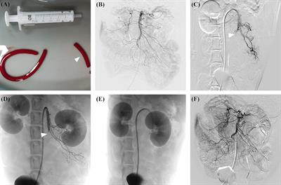 Establishment of an acute arterial mesenteric ischaemia model in canines with an endovascular approach